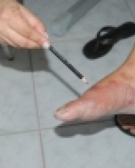 Imagem de Saúde promove campanha contra Hanseníase