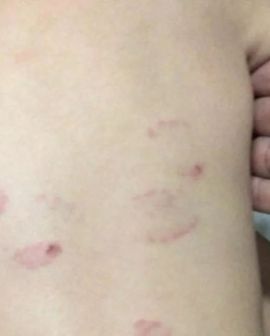 Imagem de Cuidadoras devem responder por lesão corporal no caso de bebê mordida em creche