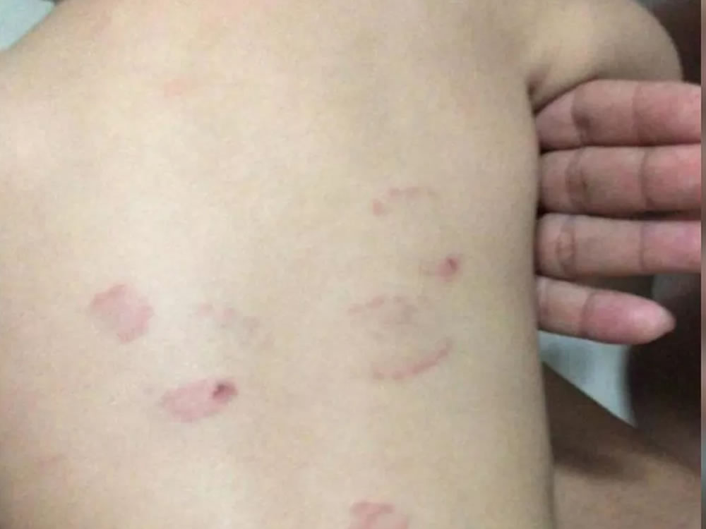 Imagem de Mãe denuncia que bebê foi mordida 15 vezes em creche de Rio Verde