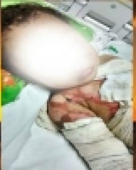 Imagem de Morre bebê que teve corpo queimado
